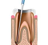 endodoncia